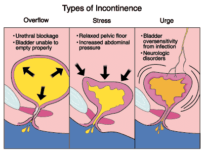 incintinence2.gif