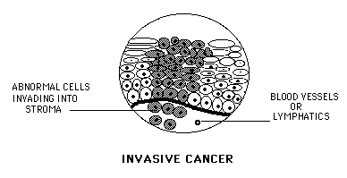 invasive-cervix.gif